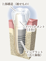implant22[1].jpg
